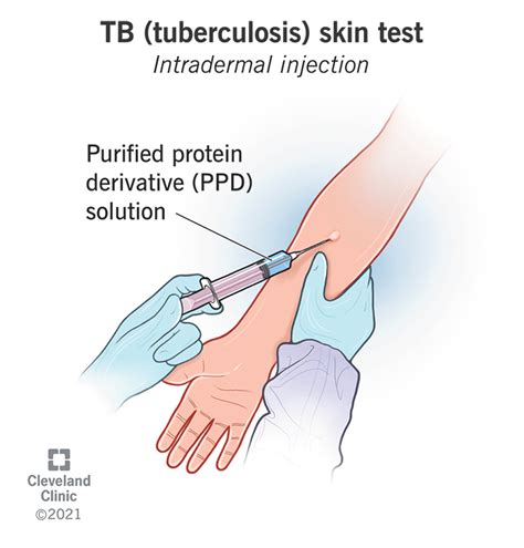 cvs tuberculosis testing|minute clinic tb test procedure.